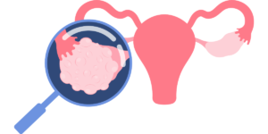 Cysty na vaječníkoch: príznaky, ako sa prejavujú cysty na vaječníkoch, aký sú príčiny vzniku cýst na vaječníkoch, čo sa môže stať, keď cysta na vaječníku praskne, či môže cysta na vaječníku zabrániť otehotneniu, diagnóza a liečba.