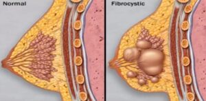 Fibrocystická mastopatie je bežný stav charakterizovaný tvorbou cystických (tekutých) oblastí a fibrotických (tvrdých) tkanív v prsníkoch.