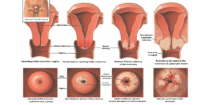 Rakovina krčka maternice je typ rakoviny, ktorý sa vyvíja v bunkách krčka maternice, čo je dolná časť maternice, ktorá sa napája na vagínu. Tento druh rakoviny je najčastejšie spôsobený infekciou ľudským papilomavírusom (HPV). Rakovina krčka maternice je z veľkej časti preventovateľná prostredníctvom očkovania, pravidelných prehliadok, zdravého životného štýlu a konzumovaniam potravín bohatých na I3C. Aký sú príznaky rakoviny krčka maternice? Aký sú faktory zvyšujúce riziko vzniku rakoviny krčka maternice? Diagnostika? Prevencia? Liečba? Čítaj viac v texte. 