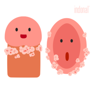 Kondylomy: príznaky, prenos a ako sa ich zbaviť prirodzene. Kondylomy sa najčastejšie prejavujú ako malé, mäkké výrastky farby kože alebo ružovkasté, niekedy zoskupené do útvarov pripomínajúcich karfiol. Môžu spôsobovať svrbenie alebo podráždenie, no u mnohých ľudí nepôsobia žiadne ťažkosti – a práve preto si ich často všimnú až neskoro.